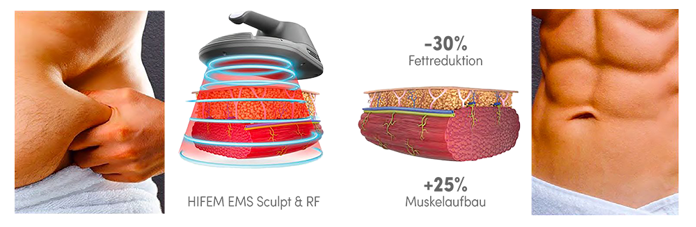 HIFEM EMS Sculpting und RF Wirkungsweise